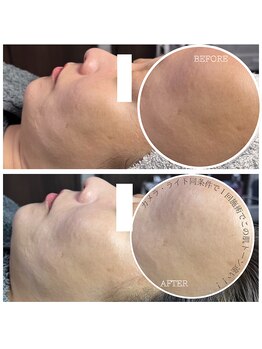 カルナ(CARNA)/スキンメイド１回施術施術前後