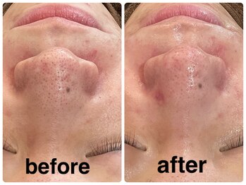 デューン 蕨店(Dune)/オプション◆毛穴洗浄