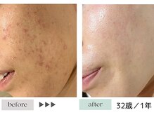 ハイケア グラン ギンザ(HYCARE GRAND GINZA)/日本ーの肌改善サロン実力/銀座