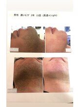 ファミリーセルフサロン 輪(Wa)/メンズヒゲ脱毛