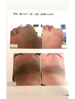 ファミリーセルフサロン 輪(Wa)/メンズヒゲ脱毛