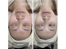 メイリー(MEILI)/Eライト光フェイシャル