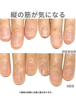 50代/爪の縦すじがきになる