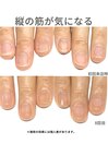 50代/爪の縦すじがきになる