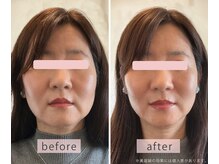 いとう鍼灸整体院 代官山恵比寿/美容鍼ビフォーアフター