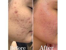 命の洗濯/８ヶ月/ニキビも凹凸も綺麗に◎