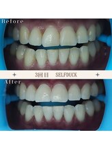 セルフダック 京都長岡京店/◇ホワイトニングの症例写真7