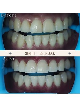セルフダック 京都長岡京店/◇ホワイトニングの症例写真7