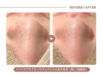 イエス マイサロン(yes My Salon)/毛穴洗浄症例
