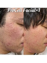 ユカリス(Yu.charis)/プロセル顔 before→after