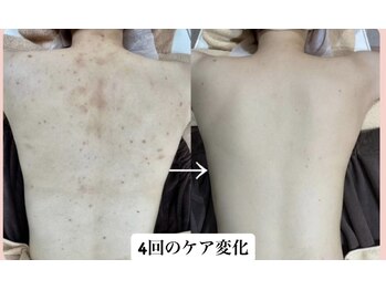 スキンハピネス(skinhappiness)/背中ハーブピーリング