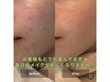 モカ 天王寺店(MOKA)/剥けない　ハーブピーリング 艶