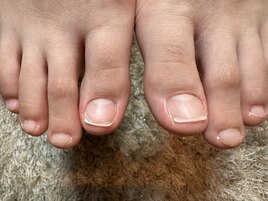 ジェルネイル前の巻き爪ケア