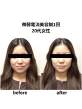 ビハダ(BIHADA)/微弱電流美容鍼　Before/After