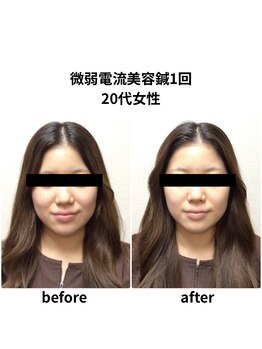 ビハダ(BIHADA)/微弱電流美容鍼　Before/After