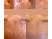 アン(An)/プラズマ、トリートメントケア