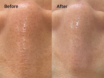 アンベリール みなとみらい店(Embellir)/毛穴洗浄beforeafter