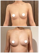 美人バスト 浦和店/【バストアップ★育乳】症例