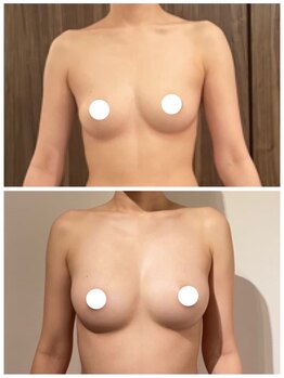 美人バスト 浦和店/【バストアップ★育乳】症例