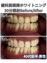 プラチナムビューティ 四条烏丸店(PLATINUM Beauty)/ホワイトニング！Before./After!