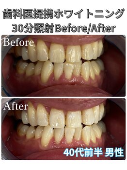 プラチナムビューティ 四条烏丸店(PLATINUM Beauty)/ホワイトニング!Before./After!