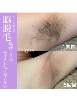 フリグス(Frigus)/【メンズ脱毛】