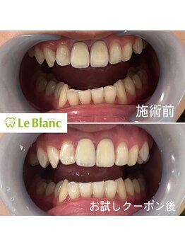 ルブラン 奈良店(Le Blanc)/差し歯があっても照射OK!