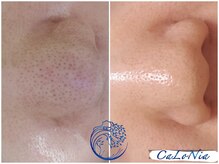 カロニア(CaLoNia)/幹細胞で活き活きとした肌へ