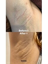 ミセレルオカザキ(MISEREL OKAZAKI)/脇脱毛