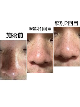 カヌヌ(Kanunu)/シミケア