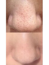 ユー(U)/毛穴洗浄コース