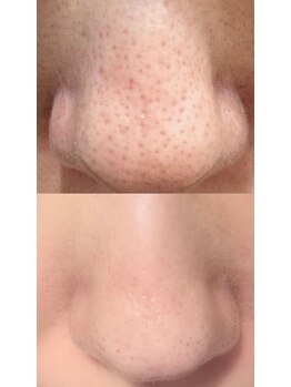 ユー(U)/毛穴洗浄コース