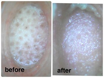 デューン 蕨店(Dune)/オプション◆毛穴洗浄