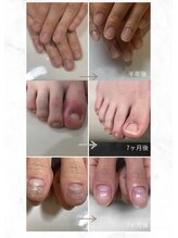 ティアラネイル 宇都宮/深爪矯正