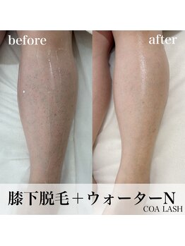 コアラッシュ 福井フェニックス通り店(COA LASH)/脱毛だけじゃない脱毛を!