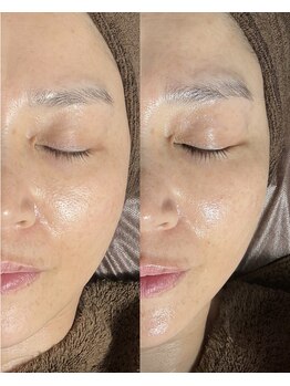 銀座エイジングケアサロン/ビフォーアフター♪