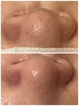 エステスタジオ アキコ(AKIKO)/小鼻の黒ずみ除去