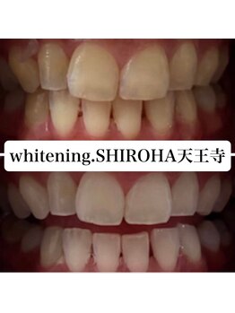 シロハ(SHIROHA)/セルフホワイトニング/天王寺