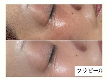 ビジュー(BIJOU)/プラピール+LDM ¥14300