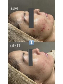 フロラスキン 銀座Miel店(florasKIN)/肌質改善