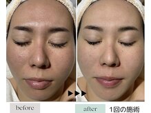 ハイケア グラン ギンザ(HYCARE GRAND GINZA)/日本ーの肌改善サロン実力/銀座