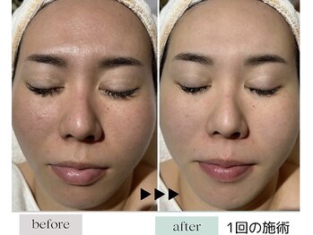 ハイケア グラン ギンザ(HYCARE GRAND GINZA)/日本ーの肌改善サロン実力/銀座