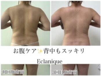 エクラニーク(Eclanique)の写真/自分の背中みたことありますか？なかなか変化が難しい背中・・・あきらめないで！