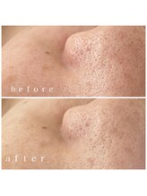 メナードフェイシャルサロン 岐阜茜部/ビタミン生パック