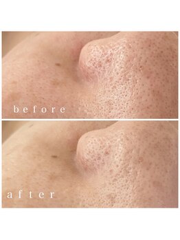 メナードフェイシャルサロン 岐阜茜部/ビタミン生パック