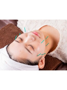 鍼灸施術を受けたい