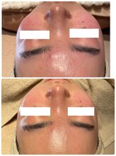 ディオーネ 春日井勝川店(Dione)/毛穴洗浄☆ビフォーアフター