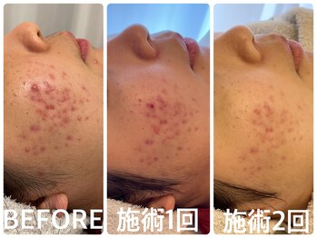 ハーブピーリング 恵比寿/ニキビ改善/色素くすみ沈着