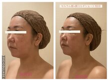 小顔コルギ専門店 フェルーシュ 成田駅前店(Feruche)/セルラム顔+顔コルギショート