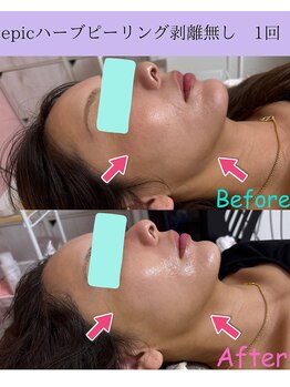 リラ(Lilas)/くすみ/小顔ハーブピーリング